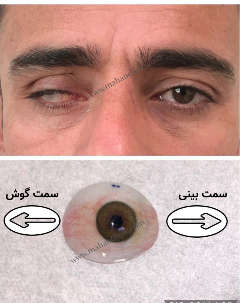 جهت قرار گیری پروتز چشم