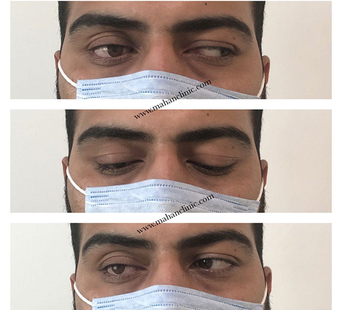 چشم مصنوعی متحرک