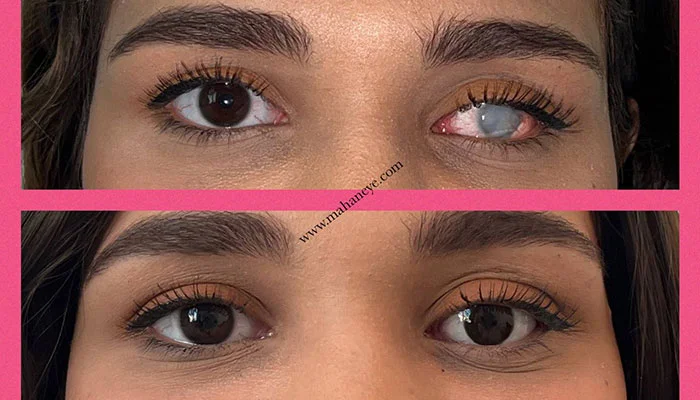 مرکز فروش چشم مصنوعی