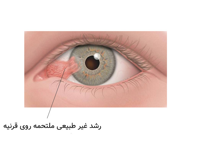 ناخنک چشم