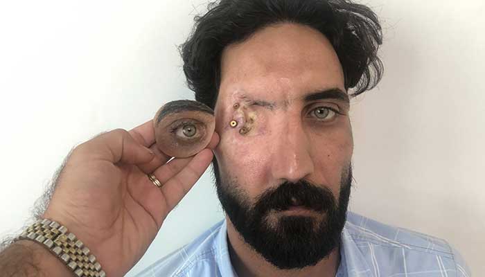 پروتز چشم اوربیتال