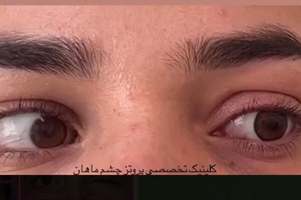 پروتز چشم متحرک