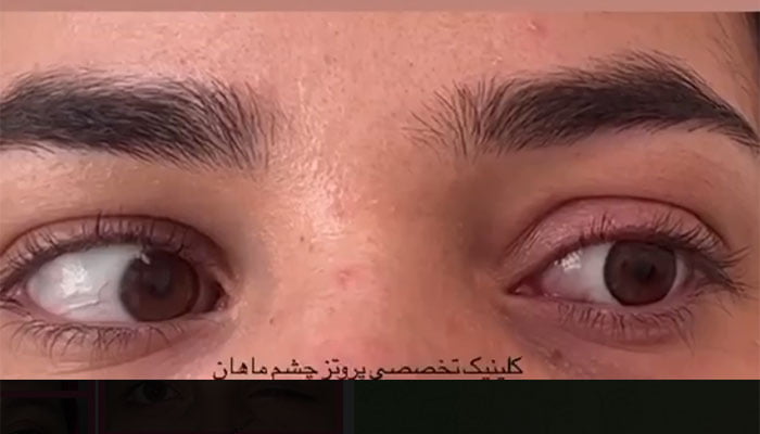 پروتز چشم متحرک