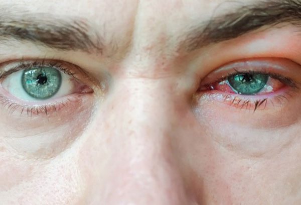 بیماری چشمی بلفاریت