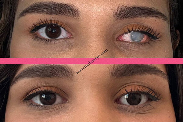 مرکز فروش چشم مصنوعی