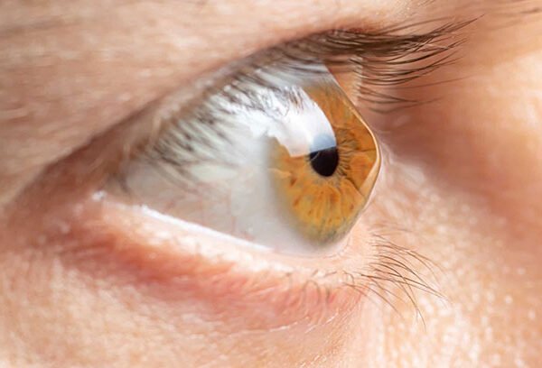 بیماری قوز قرنیه