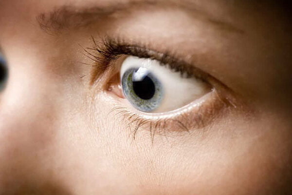 بیماری گریوز