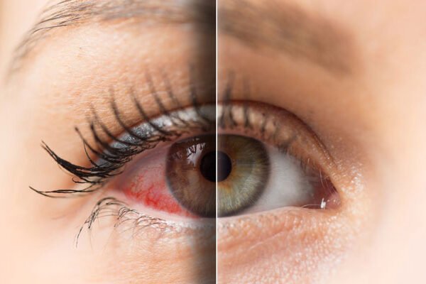 بیماری خشکی چشم