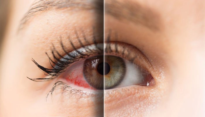 بیماری خشکی چشم