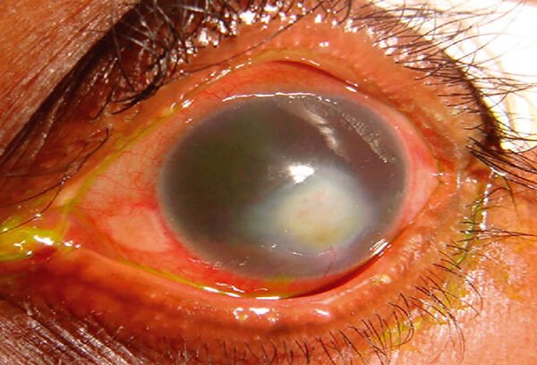 پارگی-قرنیه-چشم