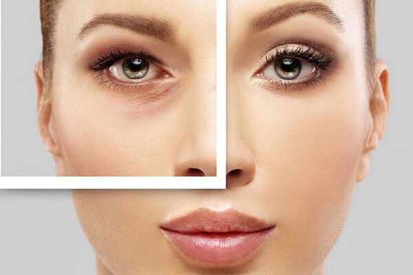 پروتز کاسه چشم