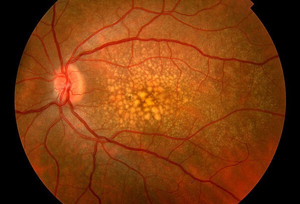 ماکولا دزنراسیون