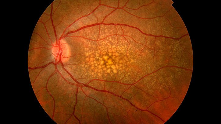 ماکولا دزنراسیون