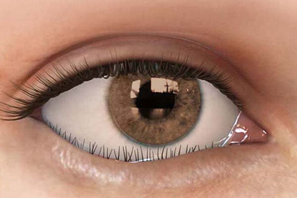 رشد مژه‌ها به سمت قرنیه