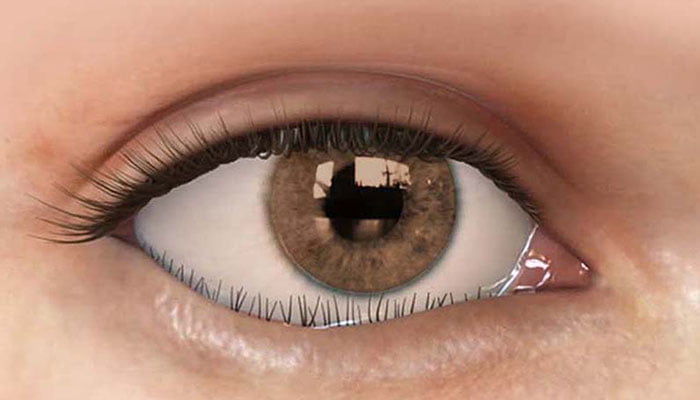 رشد مژه‌ها به سمت قرنیه