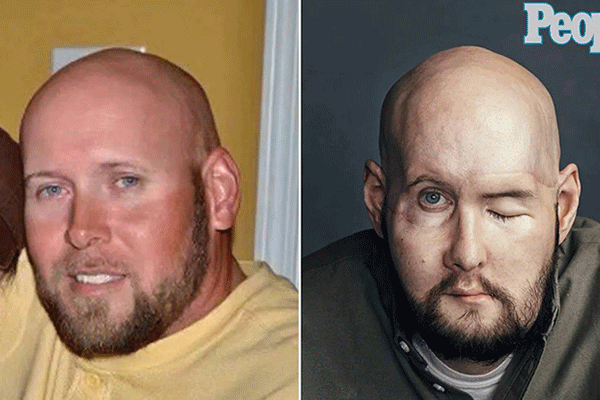 اولین پیوند موفقیت آمیز چشم