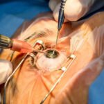 جراحی آب مروارید