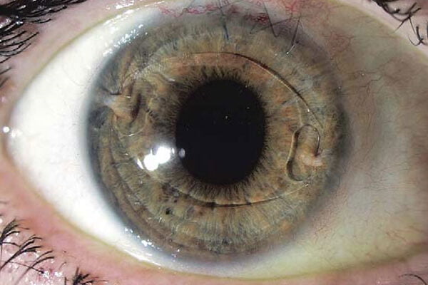 عمل کاشت لنز دائمی چشم