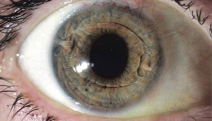 عمل کاشت لنز دائمی چشم