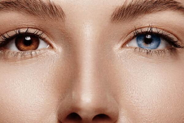 بیماری هتروکرومی فوکس