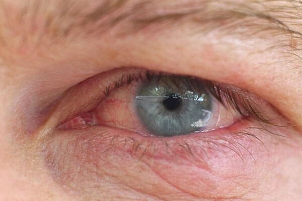 التهاب قرنیه