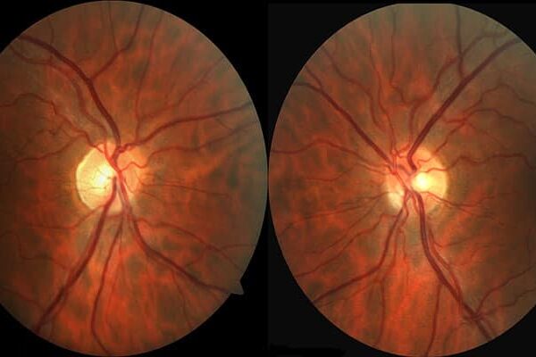 التهاب عصب بینایی