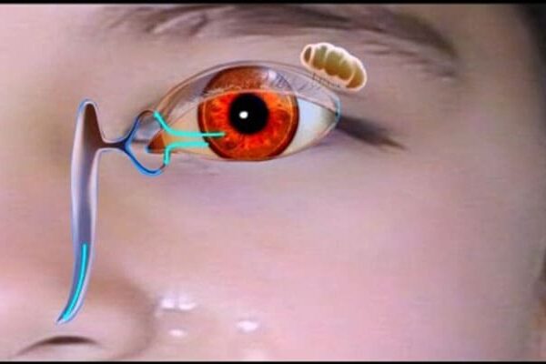 انسداد مجاری اشکی