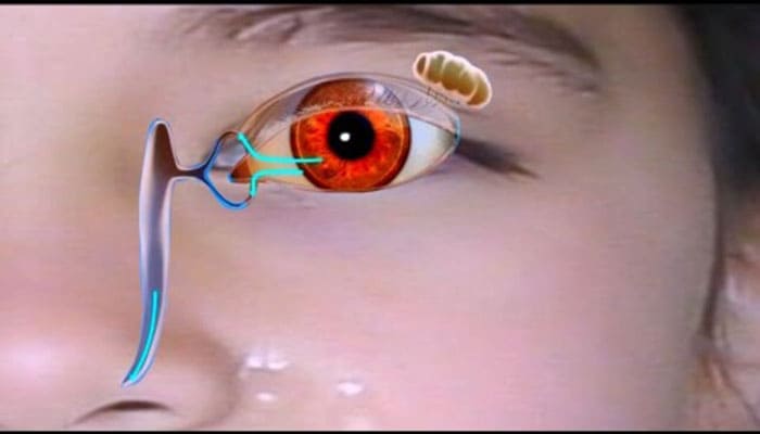 انسداد مجاری اشکی