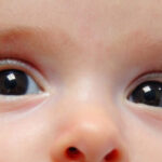 رتینوپاتی مادرزادی