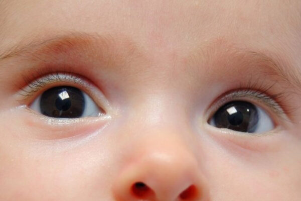 رتینوپاتی مادرزادی