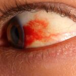 رتینوپاتی دیابتی