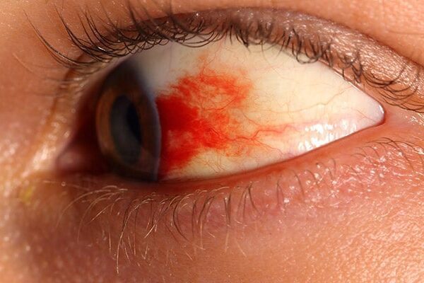 رتینوپاتی دیابتی