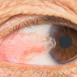 عمل ناخنک چشم