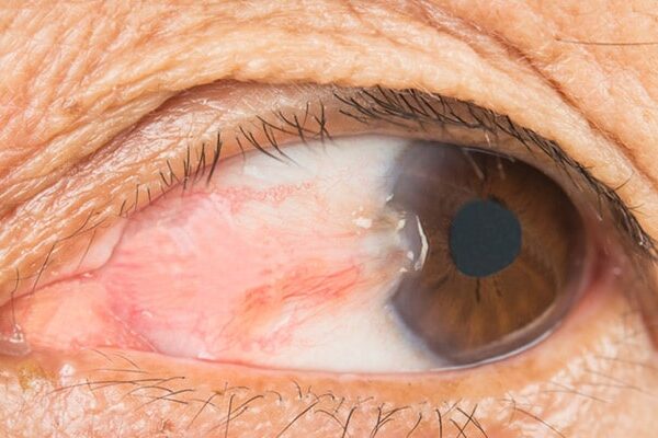 عمل ناخنک چشم