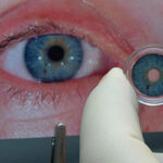 عنبیه مصنوعی