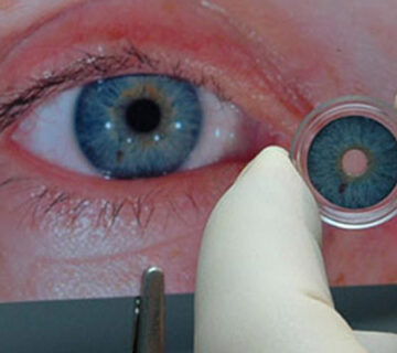 عنبیه مصنوعی