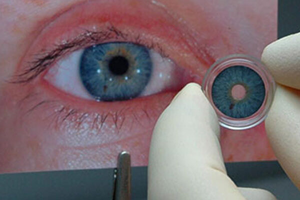 عنبیه مصنوعی