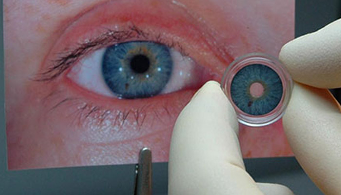 عنبیه مصنوعی