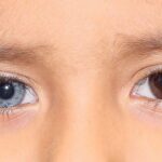 هتروکرومیا چیست؟