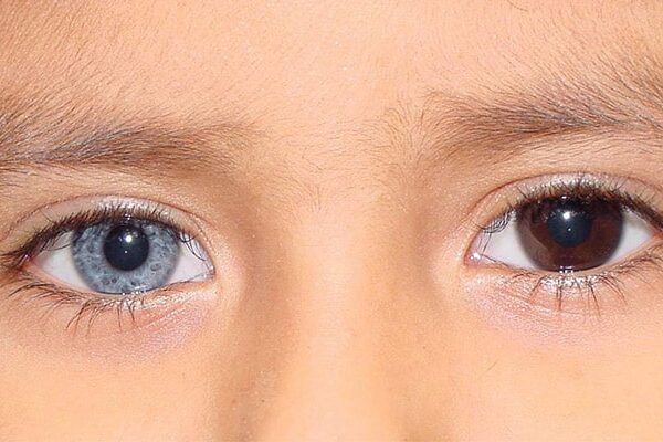 هتروکرومیا چیست؟