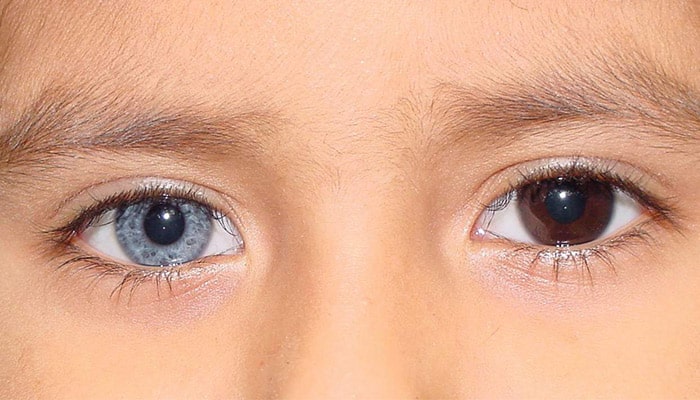 هتروکرومیا چیست؟